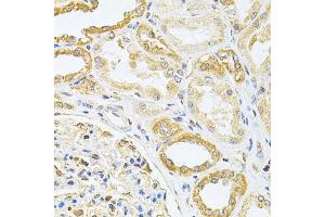 Immunohistochemistry of paraffin-embedded human kidney cancer using VAPB Antibody (ABIN1876551) at dilution of 1:200 (40x lens). (VAPB 抗体)
