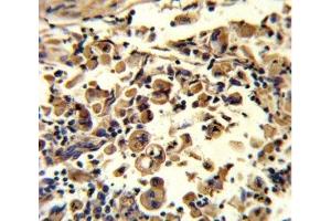 IHC analysis of FFPE human lung carcinoma stained with SOD3 antibody (SOD3 抗体  (AA 7-36))