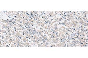Immunohistochemistry of paraffin-embedded Human liver cancer tissue using FBXO16 Polyclonal Antibody at dilution of 1:60(x200) (FBXO16 抗体)