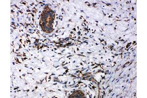 Anti-CD163 antibody, IHC(P): Human Mammary Cancer Tissue (CD163 抗体  (AA 1056-1165))