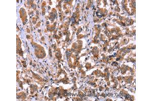 Immunohistochemistry of Human ovarian cancer using HRG Polyclonal Antibody at dilution of 1:50 (HRG 抗体)
