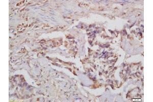 Formalin-fixed and paraffin embedded human colon carcinoma labeled with Rabbit Anti-CARD15 Polyclonal Antibody, Unconjugated  at 1:200 followed by conjugation to the secondary antibody and DAB staining (NOD2 抗体  (AA 251-350))