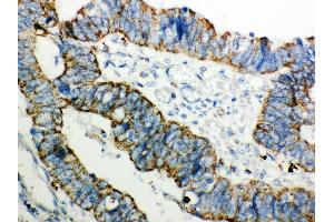 Anti- Peroxiredoxin 3 Picoband antibody,IHC(P) IHC(P): Human Intestinal Cancer Tissue (Peroxiredoxin 3 抗体  (AA 110-256))