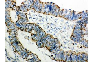Anti- Peroxiredoxin 3 Picoband antibody,IHC(P) IHC(P): Human Intestinal Cancer Tissue