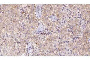 ABIN6273329 at 1/100 staining Human thyroid cancer tissue by IHC-P. (TCTN2 抗体  (Internal Region))