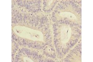 Immunohistochemistry of paraffin-embedded human colon cancer using ABIN7170629 at dilution of 1:100 (RBM17 抗体  (AA 1-240))