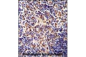 TIGD3 antibody (C-term) (ABIN654995 and ABIN2844630) immunohistochemistry analysis in formalin fixed and paraffin embedded human hodgkin lymphoma followed by peroxidase conjugation of the secondary antibody and DAB staining. (TIGD3 抗体  (C-Term))