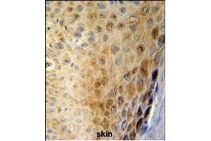 GSD Antibody (N-term) (ABIN651081 and ABIN2840063) IHC analysis in forlin fixed and paraffin embedded hun skin carcino followed by peroxidase conjugation of the secondary antibody and DAB staining. (Gasdermin A 抗体  (N-Term))