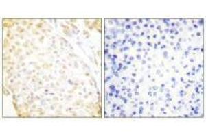 Immunohistochemistry analysis of paraffin-embedded human breast carcinoma tissue, using NKX3. (NKX3-1 抗体  (N-Term))