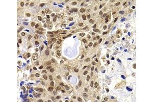 Immunohistochemistry of paraffin-embedded Human oophoroma using PHF19 Polyclonal Antibody at dilution of 1:100 (40x lens). (PHF19 抗体)