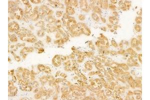 ABIN6261777 and ABIN6278175 at 1/100 staining human renal cell carcinoma by IHC-P.