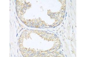 Immunohistochemistry of paraffin-embedded Human prostate using SGCB Polyclonal Antibody at dilution of 1:100 (40x lens). (SGCB 抗体)