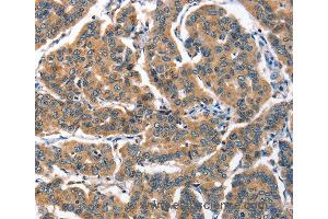 Immunohistochemistry of Human breast cancer using ALOX15 Polyclonal Antibody at dilution of 1:60 (ALOX15 抗体)