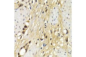 Immunohistochemistry of paraffin-embedded human stomach cancer using UAP1 antibody at dilution of 1:200 (400x lens). (UAP1 抗体)