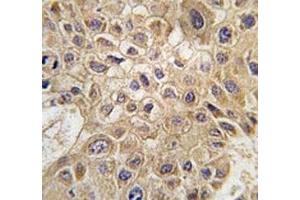 IHC analysis of FFPE human hepatocarcinoma tissue stained with AMFR antibody