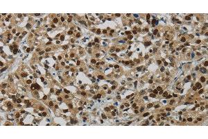 Immunohistochemistry of paraffin-embedded Human esophagus cancer tissue using DNA Ligase1 Polyclonal Antibody at dilution 1:70 (LIG1 抗体)