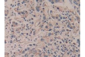 IHC-P analysis of Human Prostate cancer Tissue, with DAB staining. (APBA2 抗体  (AA 459-722))