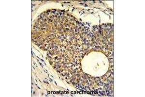 Formalin-fixed and paraffin-embedded human prostate carcinoma reacted with PHO1 Antibody (N-term), which was peroxidase-conjugated to the secondary antibody, followed by DAB staining. (Phosphate Transporter PHO1 (AA 1-30), (N-Term) 抗体)