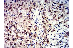 Immunohistochemical analysis of paraffin-embedded breast cancer tissues using APEX1 mouse mAb with DAB staining. (APEX1 抗体  (AA 219-318))