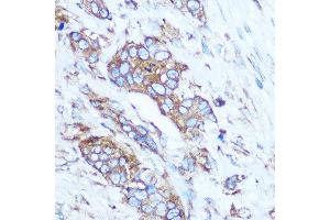 Immunohistochemistry of paraffin-embedded Human breast cancer using GSTT1 Rabbit pAb (ABIN3021870, ABIN3021871, ABIN3021872, ABIN1512971 and ABIN6216656) at dilution of 1:100 (40x lens). (GSTT1 抗体  (AA 1-240))