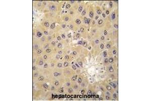 Formalin-fixed and paraffin-embedded human hepatocarcinoma tissue reacted with ACAT1 antibody (C-term) (ABIN391807 and ABIN2841659) , which was peroxidase-conjugated to the secondary antibody, followed by DAB staining. (ACAT1 抗体  (C-Term))