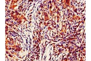 IHC image of ABIN7146946 diluted at 1:700 and staining in paraffin-embedded human pancreatic cancer performed on a Leica BondTM system. (Caspase 4 抗体  (AA 82-226))