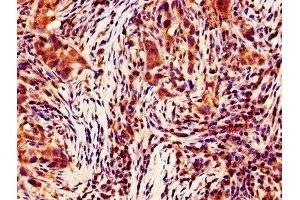 IHC image of ABIN7146946 diluted at 1:700 and staining in paraffin-embedded human pancreatic cancer performed on a Leica BondTM system.