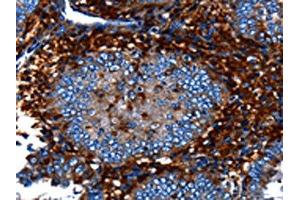 The image on the left is immunohistochemistry of paraffin-embedded Human cervical cancer tissue using ABIN7128981(CNGA2 Antibody) at dilution 1/25, on the right is treated with fusion protein. (CNGA2 抗体)