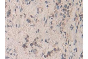 Detection of SMC3 in Human Stomach cancer Tissue using Polyclonal Antibody to Structural Maintenance Of Chromosomes Protein 3 (SMC3) (SMC3 抗体  (AA 994-1181))