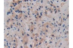 Detection of ROS1 in Human Prostate cancer Tissue using Polyclonal Antibody to C-Ros Oncogene 1, Receptor Tyrosine Kinase (ROS1)
