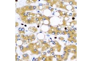 Immunohistochemical analysis of NFS1 staining in human liver cancer formalin fixed paraffin embedded tissue section. (NFS1 抗体)