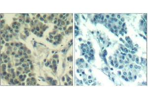 Immunohistochemical analysis of paraffin-embedded human breast carcinoma tissue using Her3/ErbB3(Phospho-Tyr1328) Antibody(left) or the same antibody preincubated with blocking peptide(right). (ERBB3 抗体  (pTyr1328))