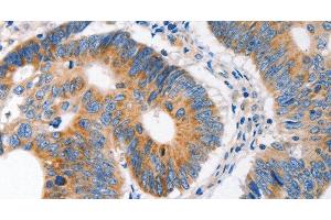 Immunohistochemistry of paraffin-embedded Human colon cancer tissue using MC1R Polyclonal Antibody at dilution 1:100 (MC1 Receptor 抗体)