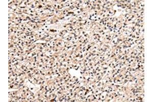 The image on the left is immunohistochemistry of paraffin-embedded Human prostate cancer tissue using ABIN7127989(PPIL1 Antibody) at dilution 1/30, on the right is treated with fusion protein. (PPIL1 抗体)