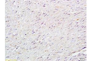 Formalin-fixed and paraffin: human cervical carcinoma labeled with Anti-RB1CC1 Polyclonal Antibody , Unconjugated at 1:200 followed by conjugation to the secondary antibody and DAB staining (FIP200 抗体  (AA 501-600))