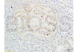 Formalin-fixed and paraffin embedded human oral squamous cell carcinoma labeled with Anti-Phospho-FoxO3a (Ser318/321) Polyclonal Antibody, Unconjugated (ABIN684688) at 1:200 followed by conjugation to the secondary antibody and DAB staining (FOXO3 抗体  (pSer318, pSer321))