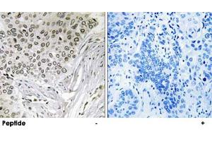 Immunohistochemistry analysis of paraffin-embedded human lung carcinoma tissue, using EFTUD2 polyclonal antibody . (EFTUD2 抗体)