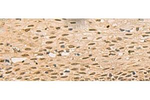 Immunohistochemistry of paraffin-embedded Human cervical cancer tissue using FOXH1 Polyclonal Antibody at dilution of 1:40(x200) (FOXH1 抗体)