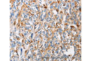 Immunohistochemistry of Human thyroid cancer using CTSL Polyclonal Antibody at dilution of 1:50 (Cathepsin L 抗体)