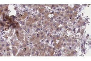 ABIN6277419 at 1/100 staining Human liver cancer tissue by IHC-P. (P2RY11 抗体)
