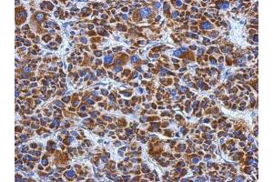 IHC-P Image Immunohistochemical analysis of paraffin-embedded human hepatoma, using DLD, antibody at 1:500 dilution. (DLD 抗体)