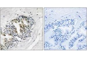 Immunohistochemistry analysis of paraffin-embedded human prostate carcinoma tissue, using RPLP2 Antibody. (RPLP2 抗体  (AA 21-70))