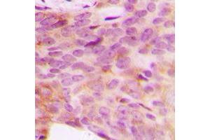 Immunohistochemical analysis of NDUFV3 staining in human breast cancer formalin fixed paraffin embedded tissue section. (NDUFV3 抗体  (Center))