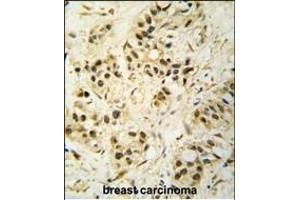 Formalin-fixed and paraffin-embedded human breast carcinoma tissue reacted with CDK1 Antibody (T14) (ABIN391744 and ABIN2841621) , which was peroxidase-conjugated to the secondary antibody, followed by DAB staining. (CDK1 抗体  (AA 1-30))
