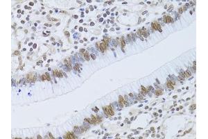 Immunohistochemistry of paraffin-embedded human gastric cancer using LMNB2 Antibody (ABIN5973877) at dilution of 1/100 (40x lens). (Lamin B2 抗体)