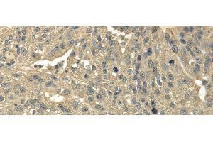 Immunohistochemistry of paraffin-embedded Human breast cancer using TRIB2 Polyclonal Antibody at dilution of 1/30 (TRIB2 抗体)
