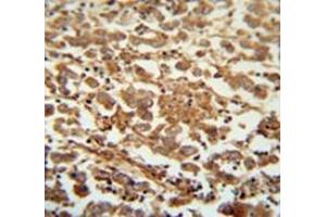 Immunohistochemistry analysis inhuman testis carcinoma (Formalin-fixed, Paraffin-embedded) using Speriolin / SPATC1 Antibody  (N-term), followed by peroxidase conjugation of the secondary antibody and DAB staining. (SPATC1 抗体  (N-Term))
