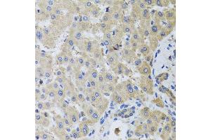 Immunohistochemistry of paraffin-embedded human liver injury using MB21D1 antibody at dilution of 1:100 (x40 lens). (C6orf150 抗体)