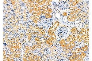 ABIN6259864 and ABIN6276627 at 1/100 staining Human kidney cancer and adjacent normal tissues by IHC-P.