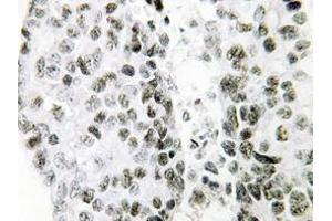 Immunohistochemistry analysis of SNAI1 antibody in paraffin-embedded Human lung carcinoma tissue. (SNAIL 抗体)